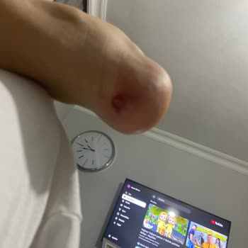 Sağlık Sorunu Yaratacak Kusurlu Adidas Ayakkabı Ve İlgisiz Müşteri Hizmetleri