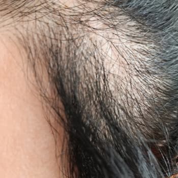 Elazığ Özel Medilines Hastanesi Plastik Ve Estetik Cerrahi Beklediğim Estetik Sonuç Oluşmadı