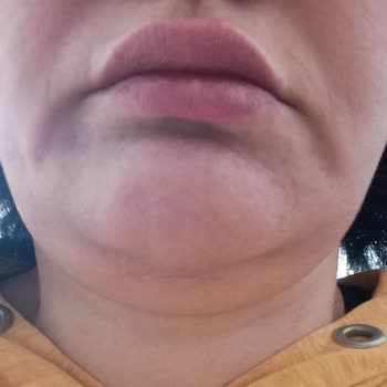 Elazığ Özel Medilines Hastanesi Plastik Ve Estetik Cerrahi Beklediğim Estetik Sonuç Oluşmadı