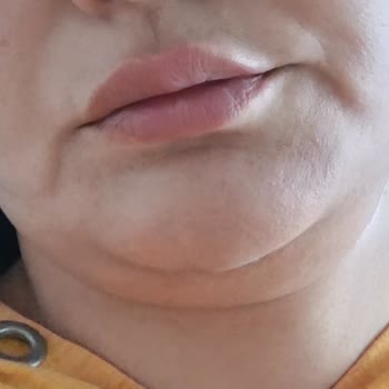 Elazığ Özel Medilines Hastanesi Plastik Ve Estetik Cerrahi Beklediğim Estetik Sonuç Oluşmadı