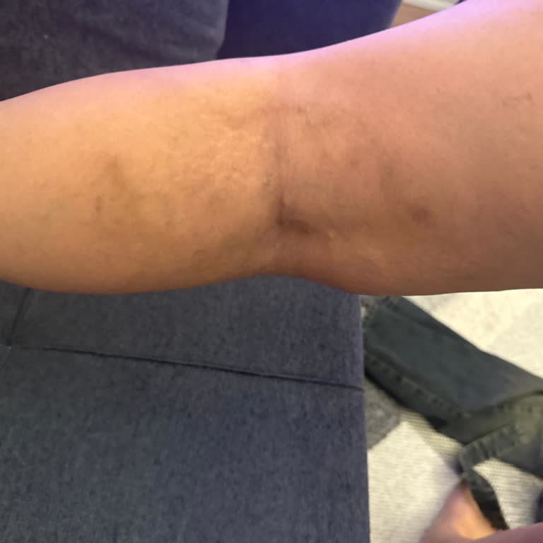 Lazer Epilasyon Sonrası Cilt Yanığı Ve Kalıcı Lekeler İçin Tazminat Talebi