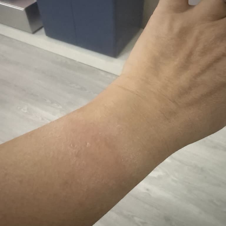 Apple Watch SE Kısa Sürede Cilt Reaksiyonu Ve Açık Kutu Nedeniyle İade Reddi