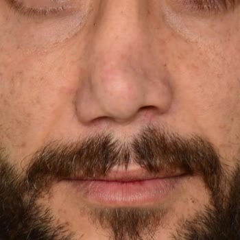 Prof. Dr. Köksal Yuca Burnum Hem Belirgin Şekilde Eğik Kaldı Hem Görüntü Olarak Hiç Memnun Kalmadım