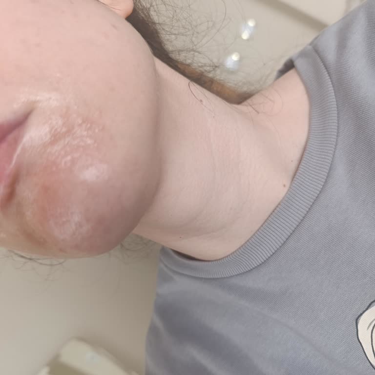 Bayer Madecassol Kremi Yüzümde Ciddi Yanık Oluşturdu