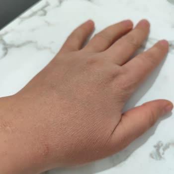 Pırıl Limonlu Bulaşık Deterjanı Nedeniyle El Derisinde Şiddetli Kaşıntı Ve Çatlaklar