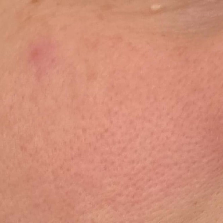 Yeni Secret Ürünü Ciltte Yanma Ve Şirketin Sorumsuzluğu