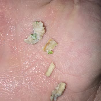 Un Paketi İçinde Yabancı Cisim, Sağlık Ve Maddi Mağduriyet