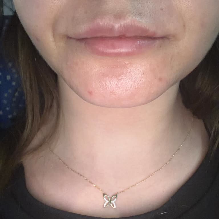 Yüz Dolgularında Hiçbir Sonuç Görülmedi, Yüksek Ücret Ve İlgisiz Hizmet