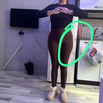 Liposuction Sonrası Kalça Asimetrisi Ve İade Talebi