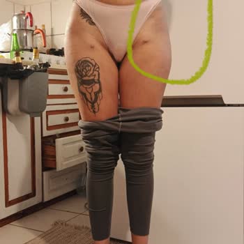 Liposuction Sonrası Kalça Asimetrisi Ve İade Talebi