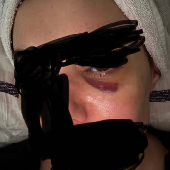 Dolgu Sonrası Uzun Süreli Hematom Ve Şişlik İçin Telafi Ve Ücret İadesi Talebi