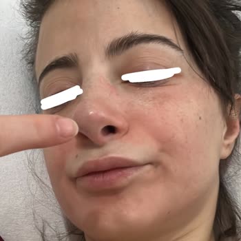 Pure Beauty Ürünleri Ciltte Şiddetli Alerjik Reaksiyon Ve Hastane Tedavisi