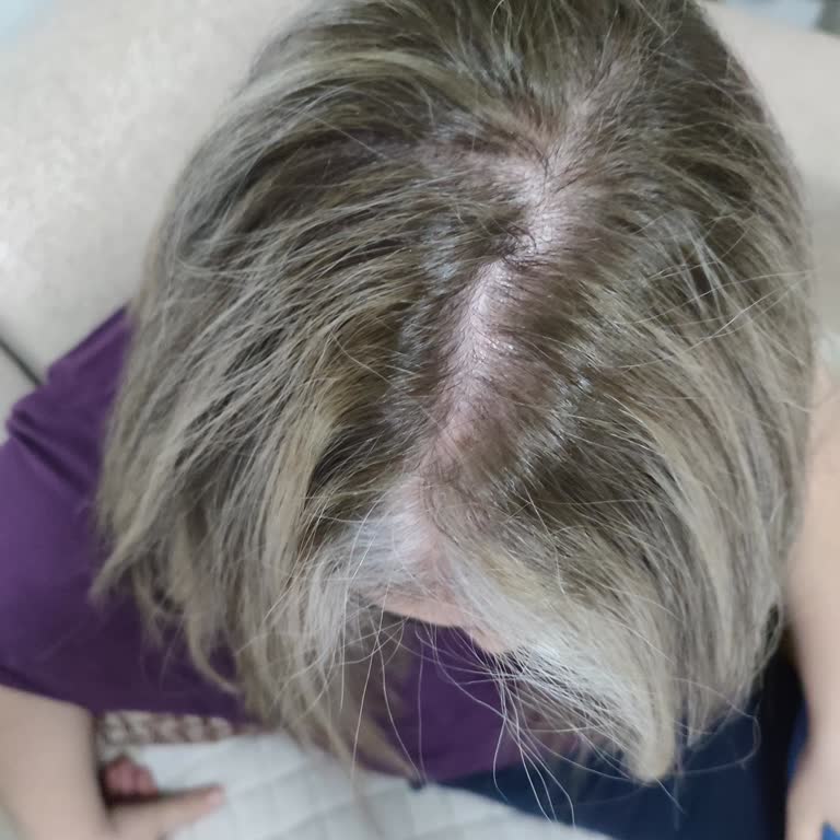 Saç Boyama İşleminde Yanma Ve Yeşile Dönüş Nedeniyle 5.500 TL İadesi Talebi