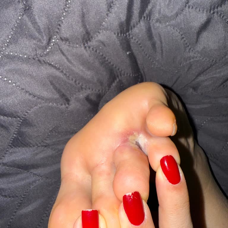 Deneme Ayakkabılarındaki Hijyen Eksikliği Ayak Enfeksiyonuna Yol Açtı