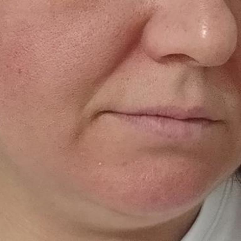 Trendyoldan Aldığım Dermavıse Peeling Jelinde Şiddetli Yanık Ve Acil Hastane Tedavisi