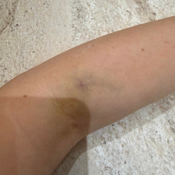 Medical Park Gebze Hastanesi'nde Hatalı Damar Yolu Açma Ve Şiddetli Ağrı İle Morarma