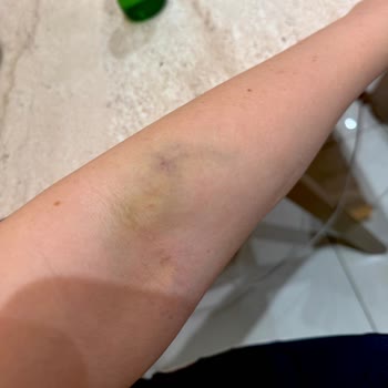 Medical Park Gebze Hastanesi'nde Hatalı Damar Yolu Açma Ve Şiddetli Ağrı İle Morarma