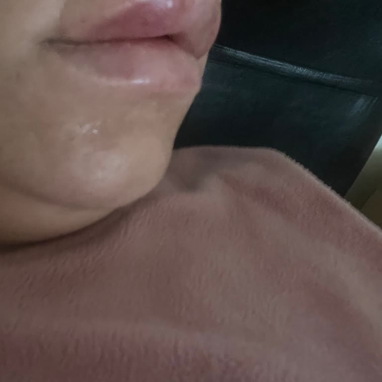 Dudak Dolgusu Sonrası Şişme Ve Deforme Görünüm İçin İade Talebi