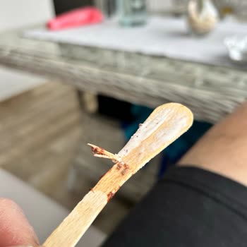 Kırık Dondurma Çubuğu Nedeniyle Ağız Yaralanması Ve Sağlık Riski