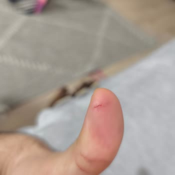 Balparmak Süzme Çiçek Balının Açılmayan Kapağı Nedeniyle Yaralanma Ve 400 TL Kayıp