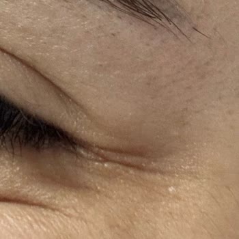 Botoks Ve Dudak Dolgusunda Başarısız Sonuçlar Ve Saygısız Tutum