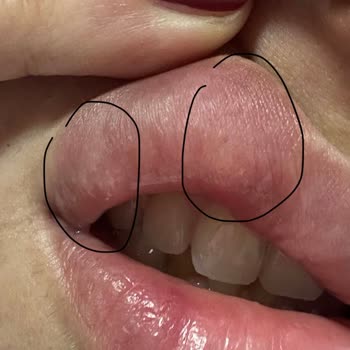 Botoks Ve Dudak Dolgusunda Başarısız Sonuçlar Ve Saygısız Tutum