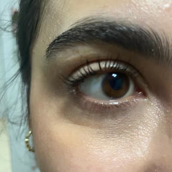 Botoks İşlemi Sonrası Şiddetli Şişlik Ve Cevapsızlık Nedeniyle Mağduriyet