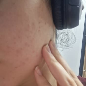 Cilt Durumu Kötüleşti, Tam İade Ve Taksit İptali Talebim