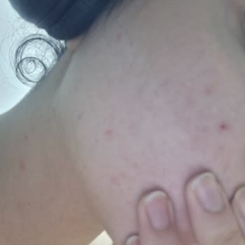 Cilt Durumu Kötüleşti, Tam İade Ve Taksit İptali Talebim