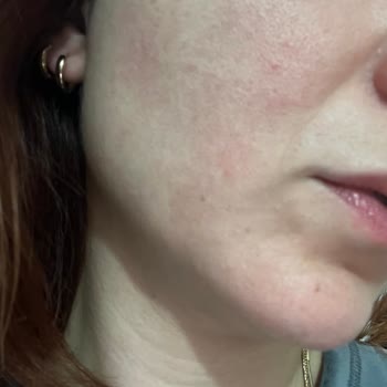 Yves Rocher Serumunda Cilt Tahrişi Ve Kızarıklık İçin Ürün Değişimi Talebi