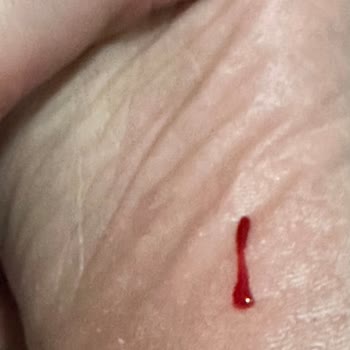 Bot İçindeki Çivi Ayağımı Deldi Ve Sağlığımı Tehdit Etti