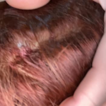 Palette Saç Boyası Uygulamasında Ağır Yanık Ve Kanama