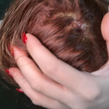 Palette Saç Boyası Uygulamasında Ağır Yanık Ve Kanama