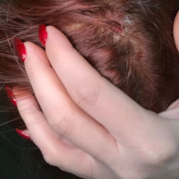 Palette Saç Boyası Uygulamasında Ağır Yanık Ve Kanama