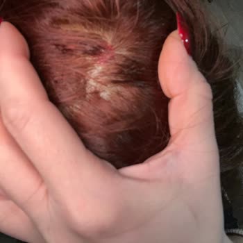 Palette Saç Boyası Uygulamasında Ağır Yanık Ve Kanama