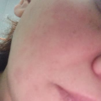 Bioxcin Güneş Kreminde Alerjik Reaksiyon Ve İade Talebi