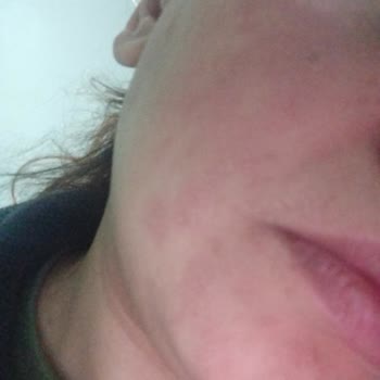 Bioxcin Güneş Kreminde Alerjik Reaksiyon Ve İade Talebi