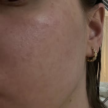 Personel Önerisiyle Aldığım Hassas Cilt Ürününde Şiddetli Alerjik Reaksiyon Ve İade Talebi