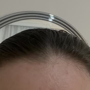 Personel Önerisiyle Aldığım Hassas Cilt Ürününde Şiddetli Alerjik Reaksiyon Ve İade Talebi