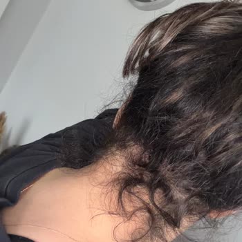 27.000 TL'lik Kaynak Saç İşlemi Sonrası Şiddetli Dökülme Ve Saygısız Yaklaşım