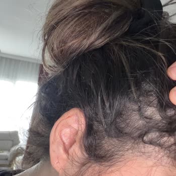 27.000 TL'lik Kaynak Saç İşlemi Sonrası Şiddetli Dökülme Ve Saygısız Yaklaşım