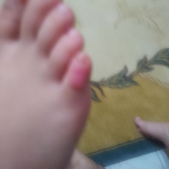 Skechers Su Geçirmez Ayakkabı Ayak Sağlığını Mahvediyor Ve İade Talebi