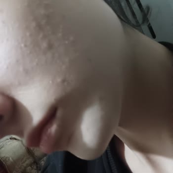 Trendyol'dan Aldığım Vully Nemlendiricisi Cilt Yanması Ve Sivilcelere Neden Oldu