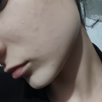 Trendyol'dan Aldığım Vully Nemlendiricisi Cilt Yanması Ve Sivilcelere Neden Oldu