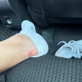 Puma Ayakkabısında İlk Kullanımda Yara Oluşması Ve İade Talebi