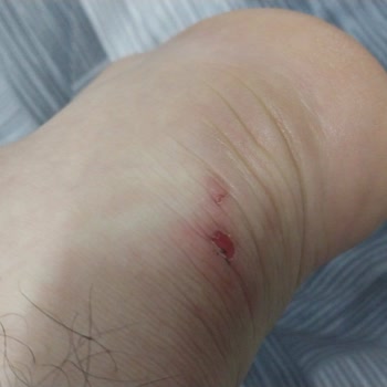 Skechers Ayakkabı Tabanı Çöktü, Mağaza Kullanıcı Hatası İddiası