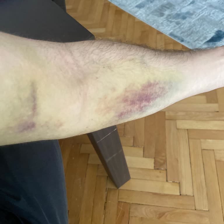 Acil Serviste Kan Alımında Dikkatsizlik Nedeniyle Şiddetli Ağrı Ve Morluk