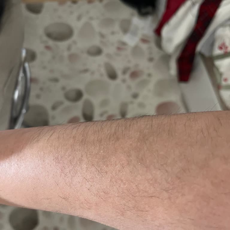 Lilium Güzellik Merkezi’nde Tam Vücut Lazer Epilasyonda Etki Görülmemesi Ve İade Talebi