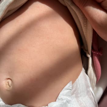 Bebekte Alerjik Dermatit: Mustela Ürünlerinden Geri Ödeme ve Açıklama Talebi