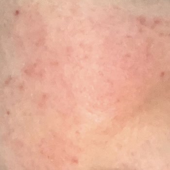 Derma Factory Kremi Yüzümde Şiddetli Kızarıklık Ve Yanma Oluşturdu